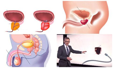 sog'lom va kasal prostata